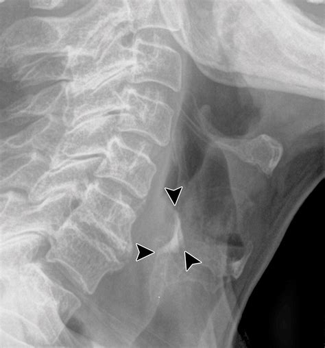 Foreign Bodies On Lateral Neck Radiographs In Adults Imaging Findings