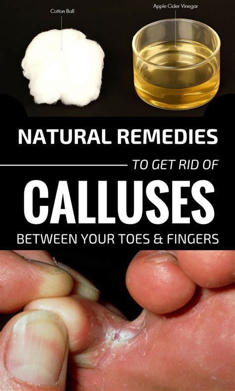 Natural Remedies To Get Rid Of Calluses Between Your Toes And Fingers