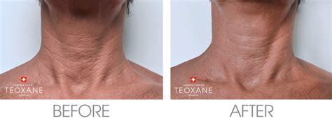 Teoxane Injectable Dermal Fillers At Orchard Dental Practice