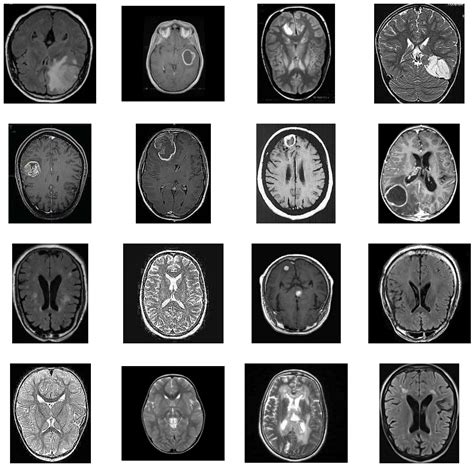 Detecting Tumors In Mri Scans Using A Convolutional Neural Network