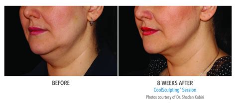 Coolsculpting Face Neck Before And After Photos Nyc