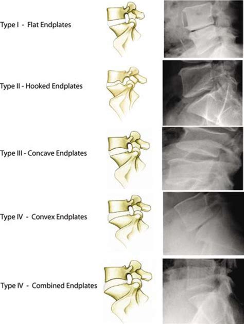 Does Vertebral Endplate Morphology Influence Outcomes In Lumbar Disc