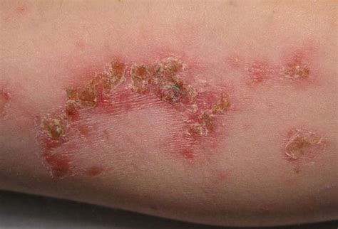 Bacterial Skin Infections Can You Make The Diagnosis