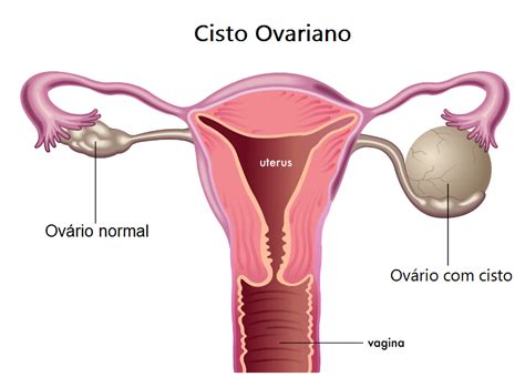 Cisto de Ovário Sintomas tratamento cirurgia e menopausa