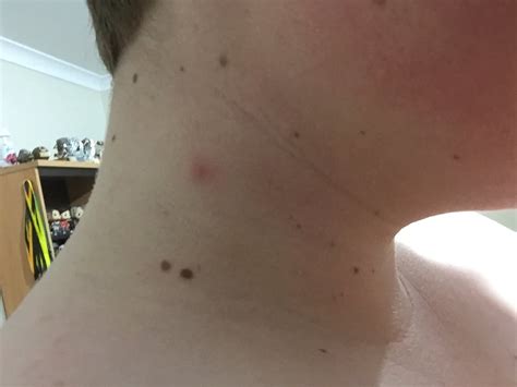 Red Spots On Neck Itchy Lesion Heralds Pervasive Problem