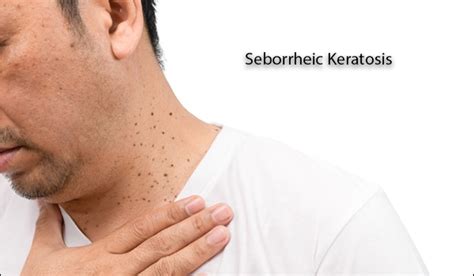 Ayurvedic Treatment Of Seborrheic Keratosis