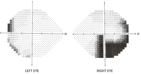 Incidental Bilateral Optic Nerve Hypoplasia Bmj Case Reports