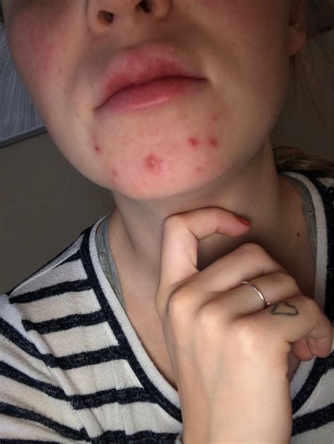 Cystic acne breakout on the chin is a severe kind of acne that can also lead to infection or inflammation. Cystic acne on chin during second trimester-HELP! | Netmums