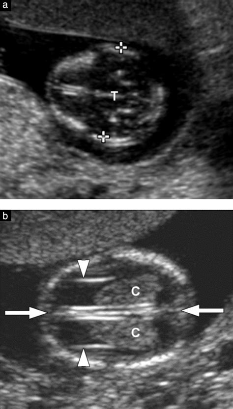 Isuog Practice Guidelines Performance Of First‐trimester Fetal