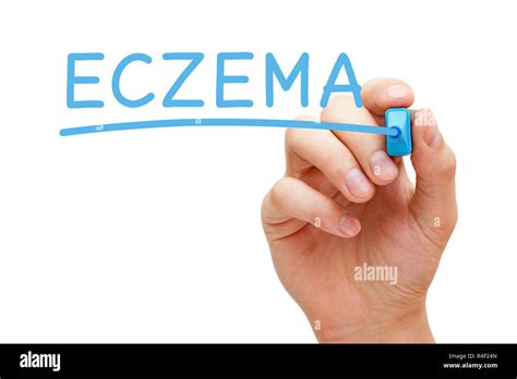Eczema Skin Blisters Hi Res Stock Photography And Images Alamy