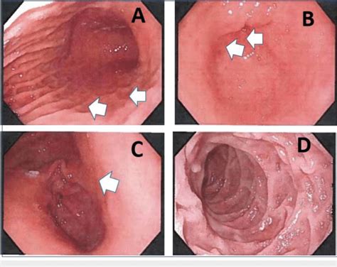 Findings from upper endoscopy ( as indicated by the white arrow) A ...
