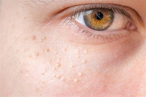 Well, also you did not mention if they are painful or no? White Bumps On Eyelid/Under Eyes: Causes & Remedies (Milia ...