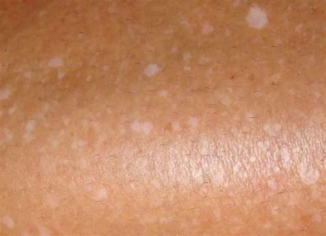 They can help determine the cause of your white spots and the best course of. White Spots on Legs, Dry Spots, Itchy, Blood Circulation ...