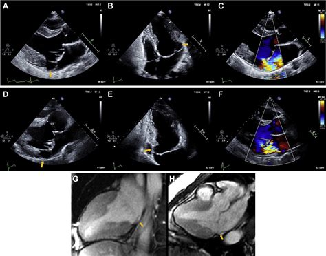 Figure 1 From Arrhythmic Mitral Valve Prolapse And Mitral Annulus