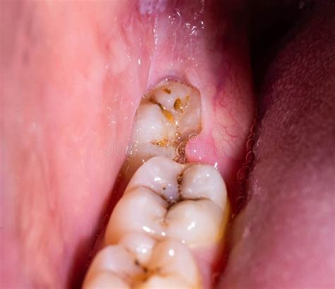 Impacted Wisdom Tooth Due To Which A Gum Hood Was Formed Inflammation