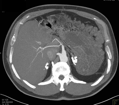 Calcified Adrenal Glands Due To Prior Granulomatous Disease Adrenal