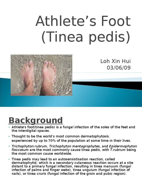 Athletes Foot Tinea Pedis Immunology Clinical Medicine