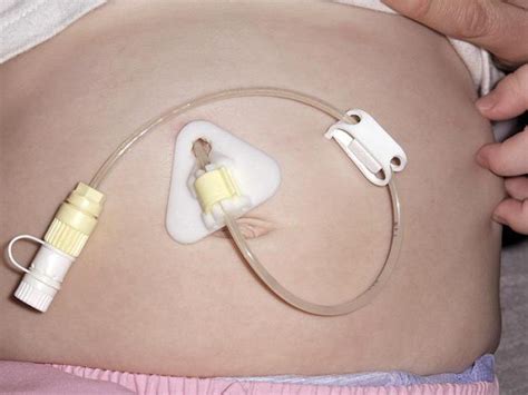 Care For Gastrostomy Feeding The Patient With A Gastrostomy