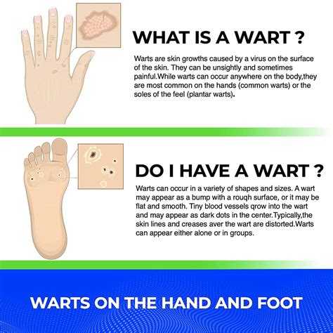 Wart Remover Liquid Rapidly Eliminates Both Plantar And Common Warts