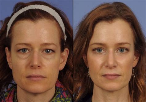Wnatural Micromidfacelift Archives Wcosmetic
