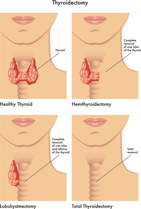 How To Code A Thyroidectomy Absolute Medical Coding Institute