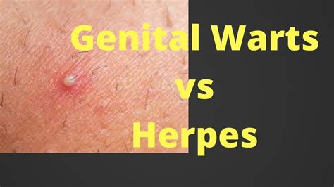 Genital Warts Vs Herpes Herpes Vs Genital Warts Difference Between