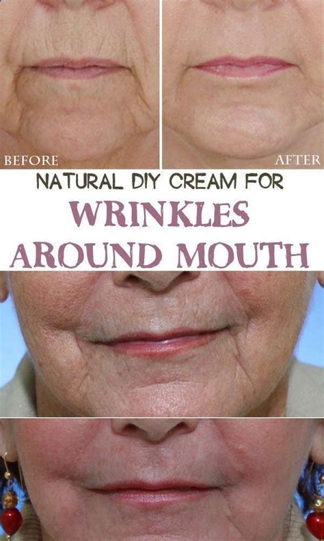 Natural Diy Cream For Wrinkles Around Mouth
