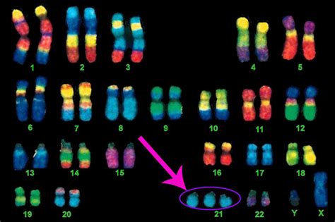 What Is Down Syndrome The 21st Chromosome Simply Explained