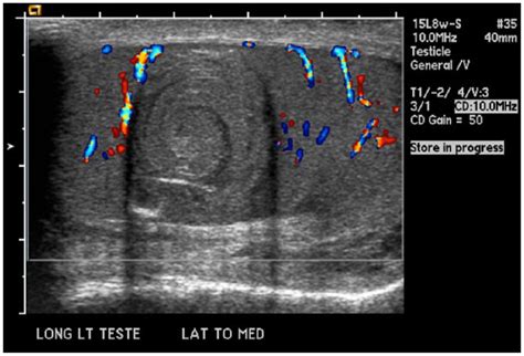 Epidermoid Cyst Of The Testis Sonographic Characteristic Appearance