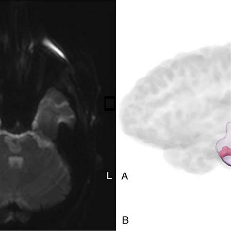 Diffusion Weighted Imaging Of The Pontine Infarct At Baseline A