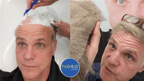 Before And After Hair System Non Surgical Hair Replacement System Men Women Uk Usa