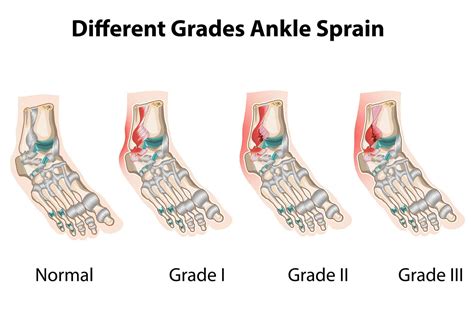 Lateral Ankle Ligament Sprains: Symptoms & Treatment – Injury Health Blog