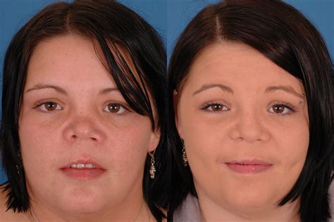 Patient 6 Revision Rhinoplasty Before And After Dallas Advanced