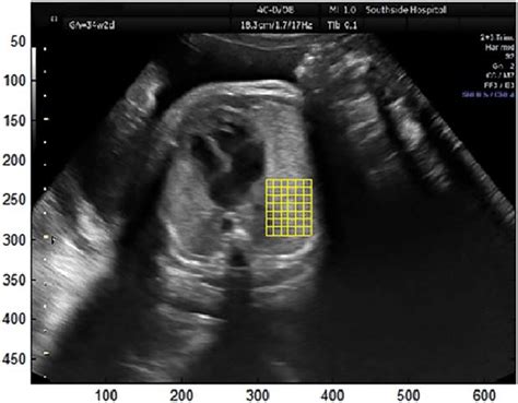 Ultrasound Image Of The Transverse View Of A Fetal Thorax Taken At The