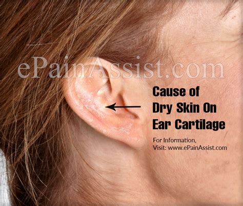 Cause Of Dry Skin On Ear Cartilage And Its Symptoms Treatments Home