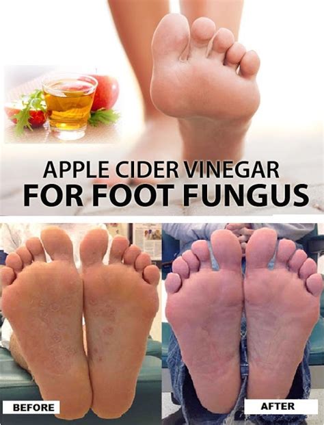 How To Get Rid Of Foot Fungus