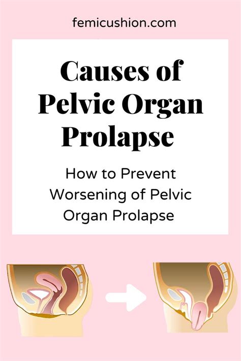 Causes Of Pelvic Organ Prolapse Pop Pelvic Organ Prolapse Bladder