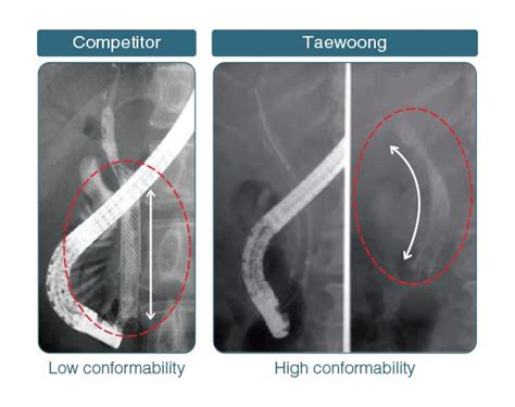Niti S Biliary D Stent Taewoong Medical