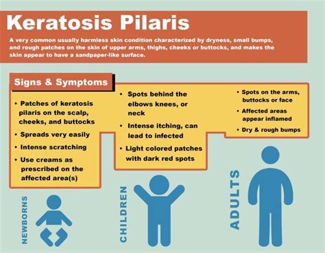 What Is Keratosis Pilaris And How Can We Treat It