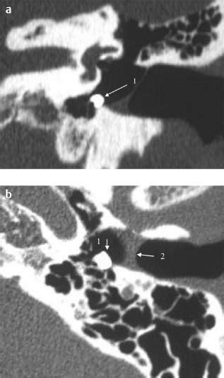 Imaging For Tympanoplasty And Mastoidectomy Ento Key