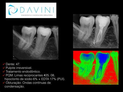 Davini Endodontia e Microscopia Operatória Tratamento endodôntico dente sessão única