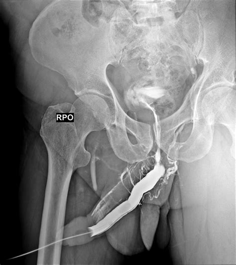 Bulbar Urethral Stricture And Venous Intravasation Image