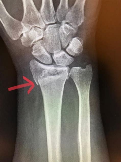 X Ray Of A Cracked Wrist