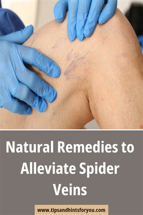 Natural Remedies To Alleviate Spider Veins In 2020 Spider Veins Natural Remedies Remedies
