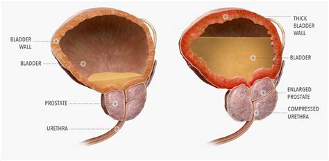 The location of the prostate in males is simple. Should men with an enlarged prostate avoid certain ...