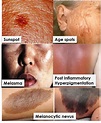 Hyperpigmentation - Understanding Dark Patches on Skin