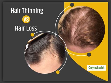 Details More Than Reasons For Thinning Hair Best In Eteachers