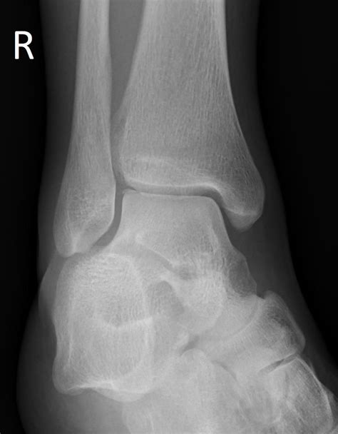A Painful Swollen Ankle After A Fall The Bmj