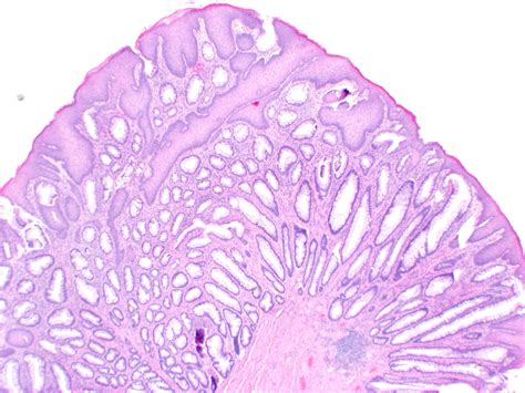 Pathology Outlines Inflammatory Cloacogenic Polyp