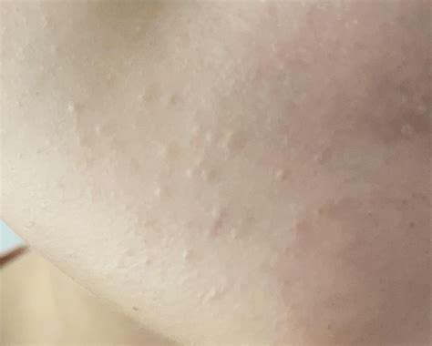 Skin Concern Tiny Skin Colored Bumps Near Chin In 2020 Skin